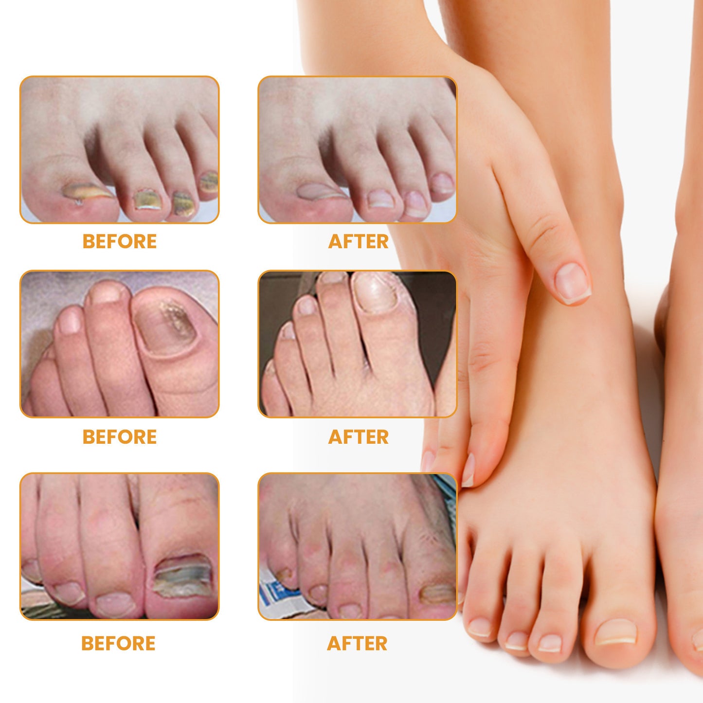 32 Pcs Ingrown Nail Repair Patch
