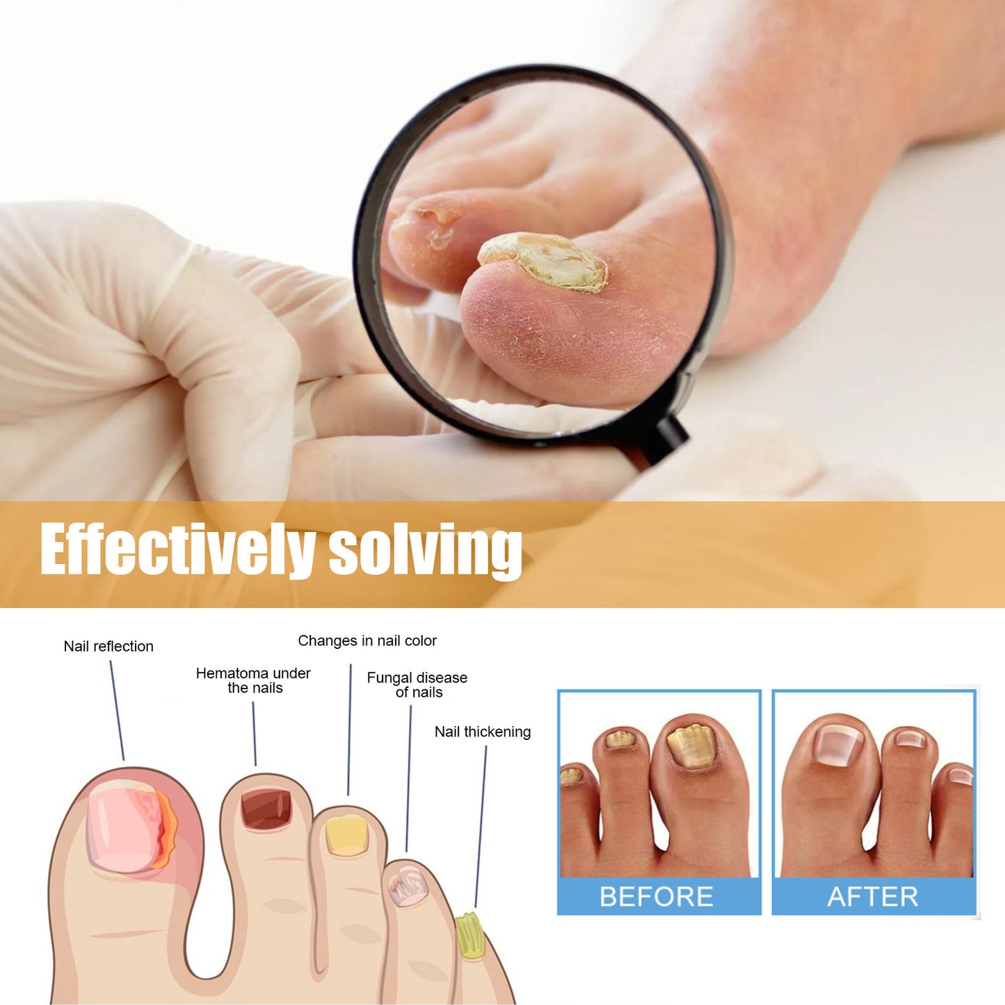 32 Pcs Ingrown Nail Repair Patch